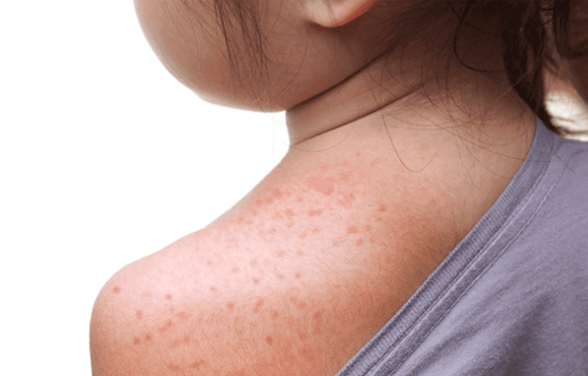 Additional measles cases bring Oklahoma total to 4 image