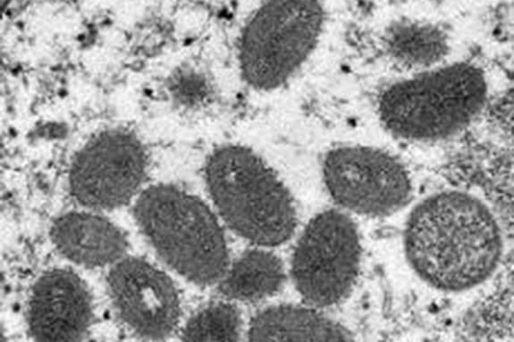 OSDH Identifies Second Probable Case of Monkeypox in Oklahoma image